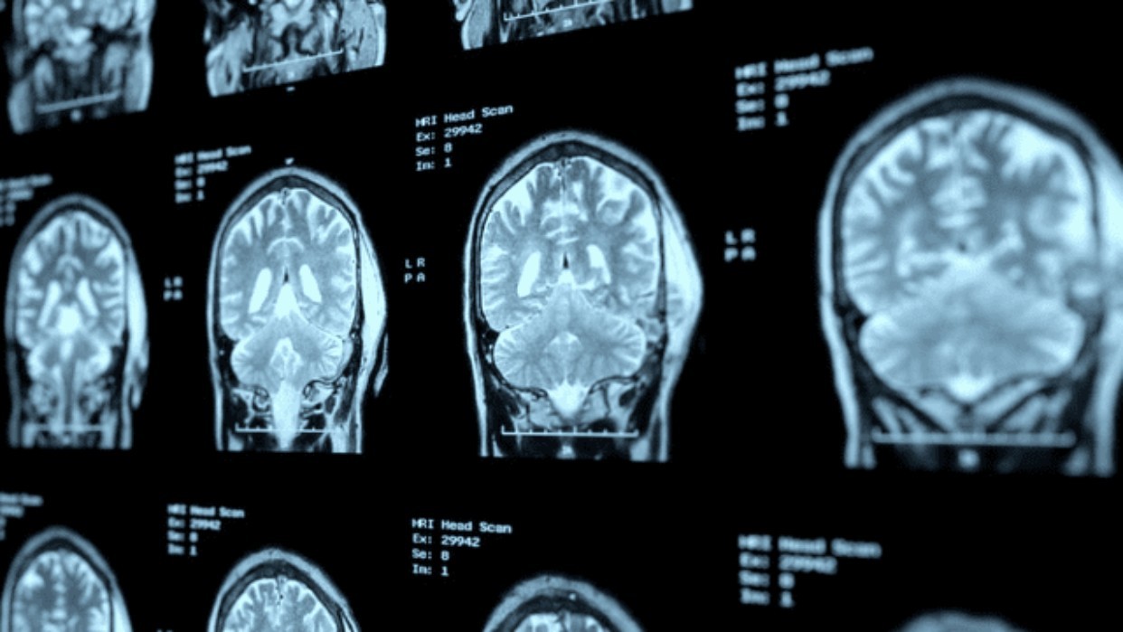 Diario Frontera, Frontera Digital,  Alzheimer en un joven de 19 años, Salud, ,Reportan el primer caso de Alzheimer en un joven de 19 años