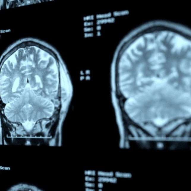 Diario Frontera, Frontera Digital,  Alzheimer en un joven de 19 años, Salud, ,Reportan el primer caso de Alzheimer en un joven de 19 años
