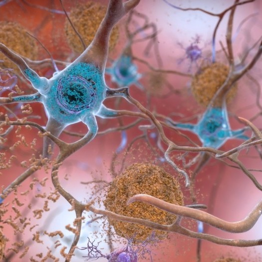 Diario Frontera, Frontera Digital,  alzhéimer, donanemab, Salud, ,La última promesa contra el alzhéimer: Eli Lilly dice que su fármaco 
frena la enfermedad en etapas tempranas