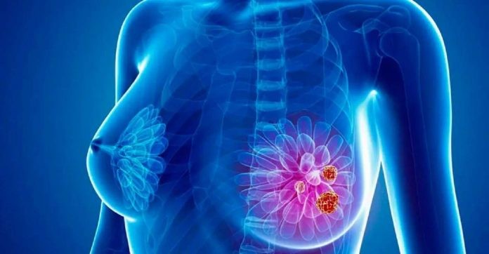 Diario Frontera, Frontera Digital,  Labiomex, ULA, CANCER DE MAMA, Salud, ,Bioanalista en Mérida trabaja en la creación de un anticuerpo 
que ayude a diagnosticar el cáncer de mama