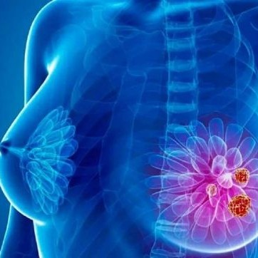 Diario Frontera, Frontera Digital,  Labiomex, ULA, CANCER DE MAMA, Salud, ,Bioanalista en Mérida trabaja en la creación de un anticuerpo 
que ayude a diagnosticar el cáncer de mama
