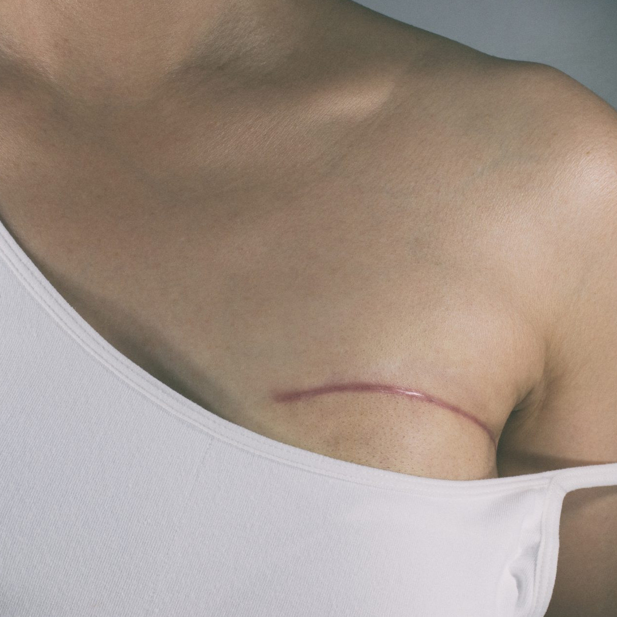 Diario Frontera, Frontera Digital,  Nacionales, Salud, ,Diez mujeres fallecen todos los días en Venezuela por diagnósticos tardíos de cáncer de mama