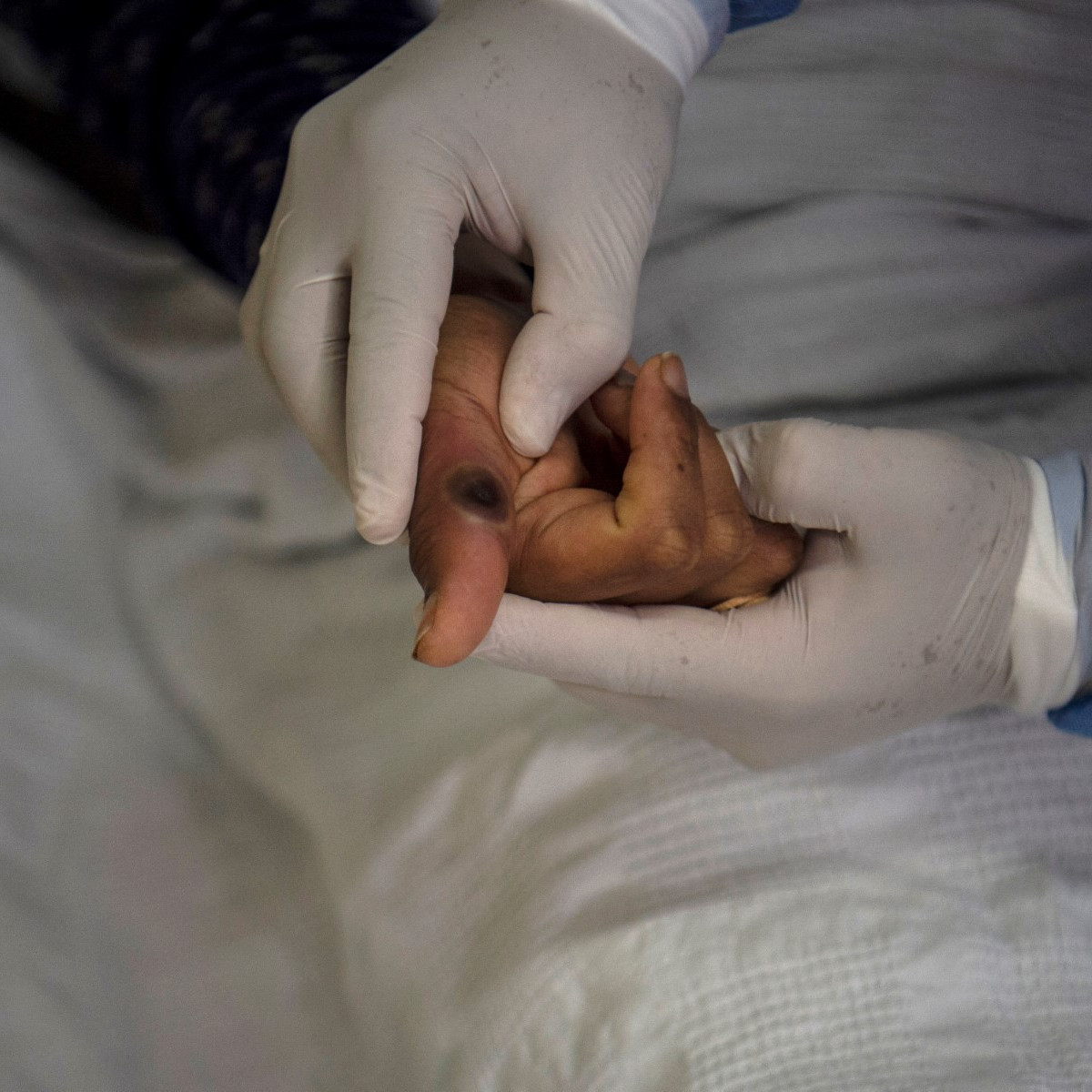 Diario Frontera, Frontera Digital,  Salud, ,Viruela del mono: Venezuela anuncia un plan de vigilancia epidemiológica