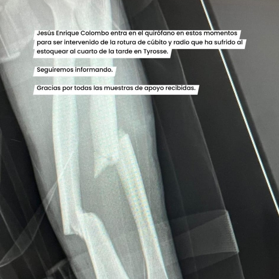 Diario Frontera, Frontera Digital,  Entretenimiento, ,“Colombo” afronta con resignación parón a causa de la fractura de su antebrazo izquierdo